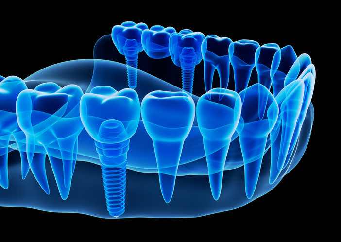 3D image of dental implants at Alexandra Garcia, DDS, MS in Houston, TX